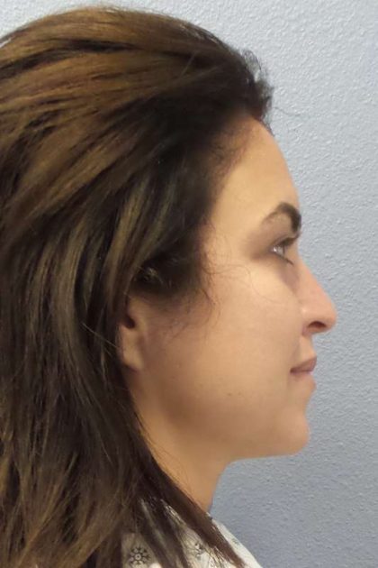 Rhinoplasty Before & After Patient #9969