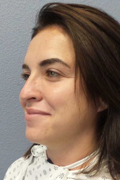 Rhinoplasty Before & After Patient #9969