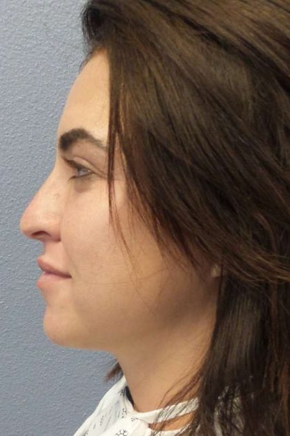 Rhinoplasty Before & After Patient #9969