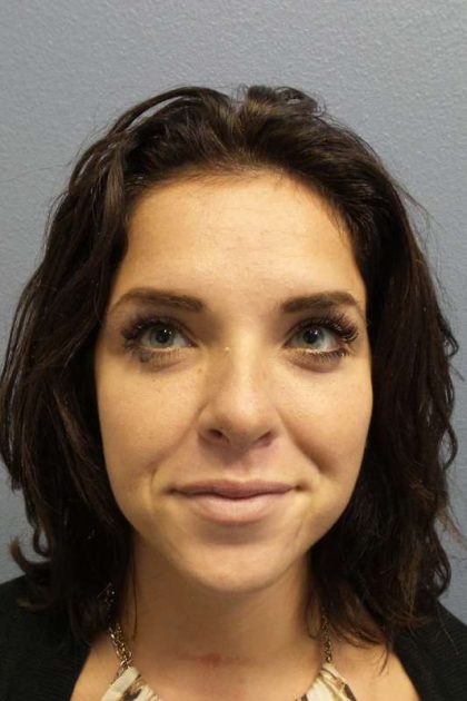 Rhinoplasty Before & After Patient #9969