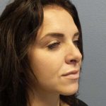 Rhinoplasty Before & After Patient #9969