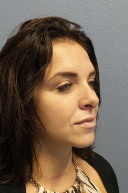 Rhinoplasty Before & After Patient #9969