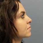 Rhinoplasty Before & After Patient #9969
