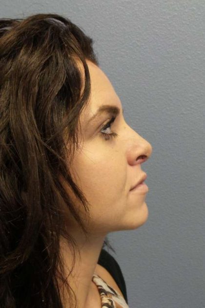 Rhinoplasty Before & After Patient #9969