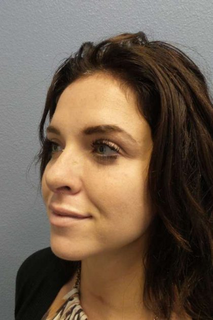 Rhinoplasty Before & After Patient #9969