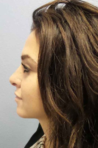 Rhinoplasty Before & After Patient #9969