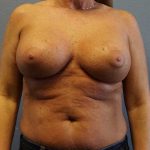 Breast Lift with Implant (Augmentation Mastopexy) Before & After Patient #4438