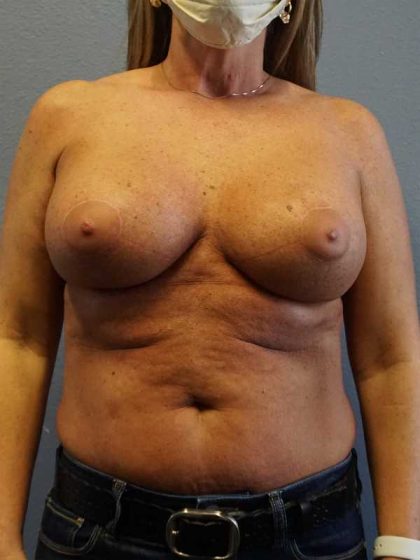 Breast Lift with Implant (Augmentation Mastopexy) Before & After Patient #4438