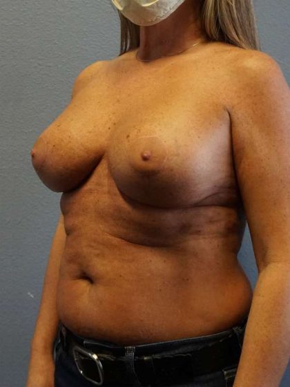 Breast Lift with Implant (Augmentation Mastopexy) Before & After Patient #4438