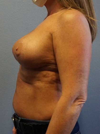 Breast Lift with Implant (Augmentation Mastopexy) Before & After Patient #4438