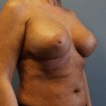 Breast Lift with Implant (Augmentation Mastopexy) Before & After Patient #4438