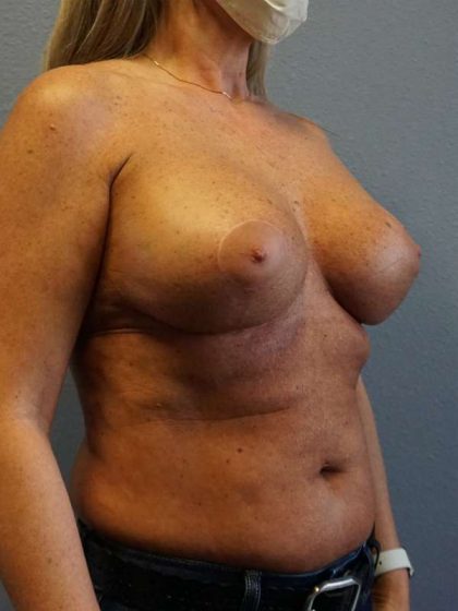 Breast Lift with Implant (Augmentation Mastopexy) Before & After Patient #4438