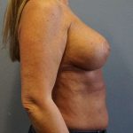 Breast Lift with Implant (Augmentation Mastopexy) Before & After Patient #4438