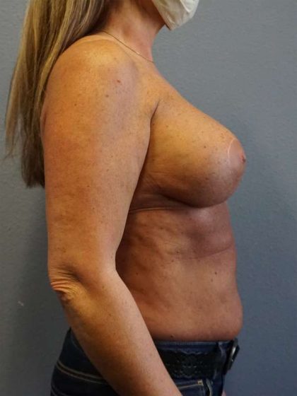 Breast Lift with Implant (Augmentation Mastopexy) Before & After Patient #4438