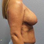 Breast Lift with Implant (Augmentation Mastopexy) Before & After Patient #4438