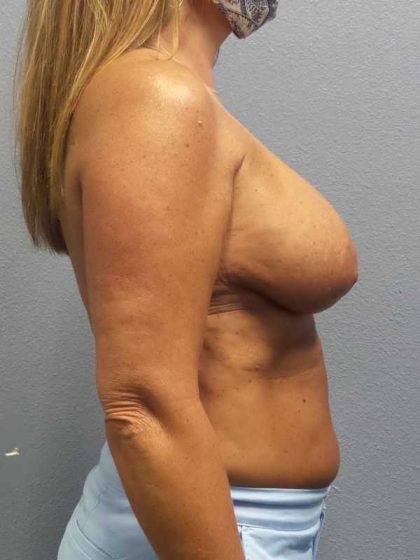 Breast Lift with Implant (Augmentation Mastopexy) Before & After Patient #4438