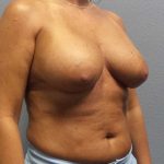 Breast Lift with Implant (Augmentation Mastopexy) Before & After Patient #4438