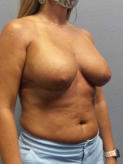 Breast Lift with Implant (Augmentation Mastopexy) Before & After Patient #4438