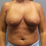 Breast Lift with Implant (Augmentation Mastopexy) Before & After Patient #4438