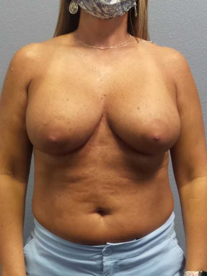Breast Lift with Implant (Augmentation Mastopexy) Before & After Patient #4438
