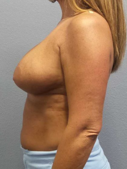 Breast Lift with Implant (Augmentation Mastopexy) Before & After Patient #4438