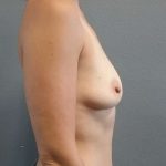 Breast Augmentation Before & After Patient #5694