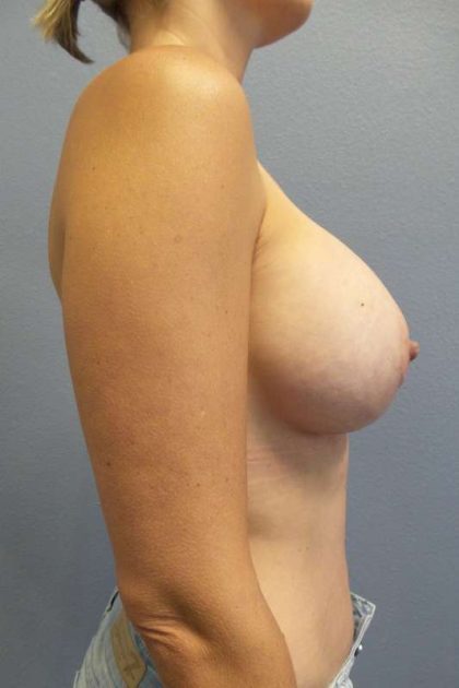 Breast Augmentation Before & After Patient #5694