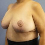 Breast Reduction Before & After Patient #7454