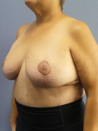 Breast Reduction Before & After Patient #7454