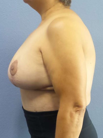 Breast Reduction Before & After Patient #7454