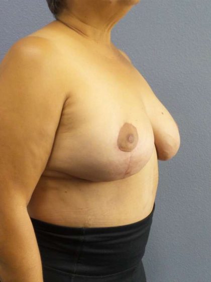 Breast Reduction Before & After Patient #7454