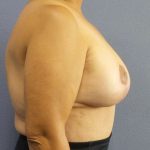 Breast Reduction Before & After Patient #7454