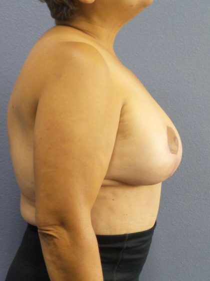 Breast Reduction Before & After Patient #7454