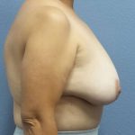 Breast Reduction Before & After Patient #7454