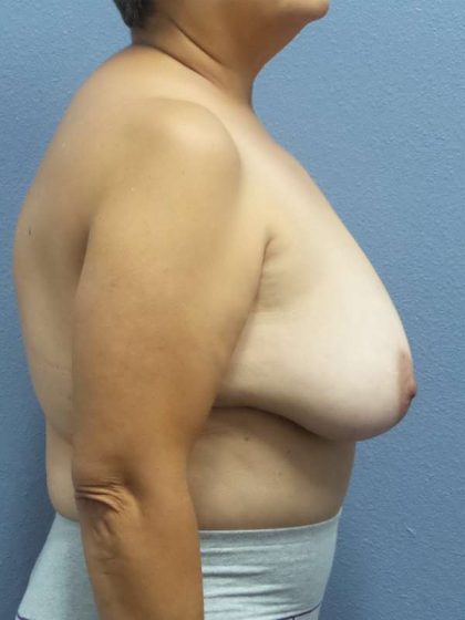 Breast Reduction Before & After Patient #7454
