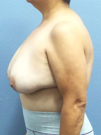 Breast Reduction Before & After Patient #7454