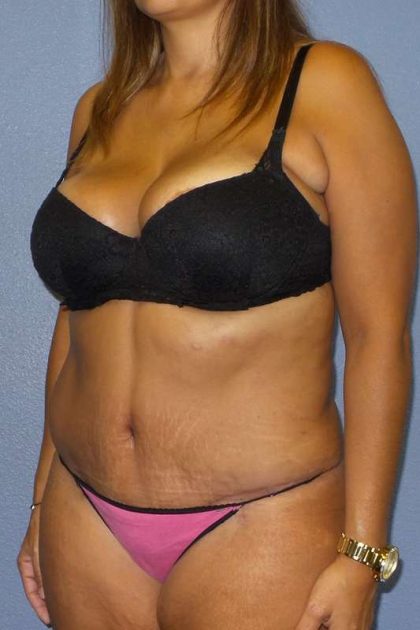 Abdominoplasty Before & After Patient #3763