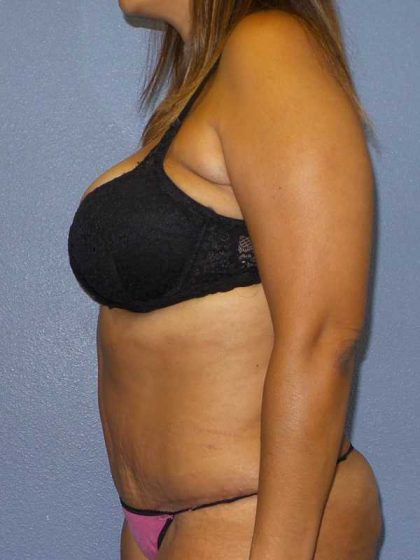 Abdominoplasty Before & After Patient #3763