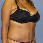 Abdominoplasty Before & After Patient #3763