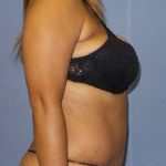 Abdominoplasty Before & After Patient #3763