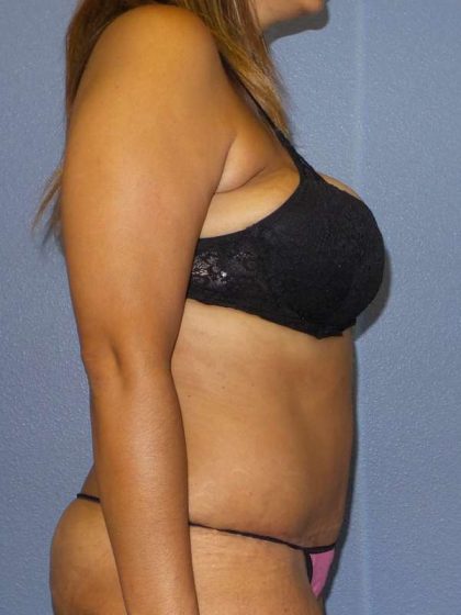 Abdominoplasty Before & After Patient #3763