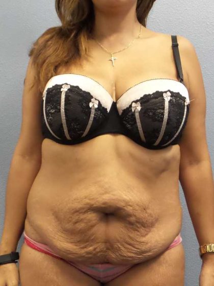 Abdominoplasty Before & After Patient #3763