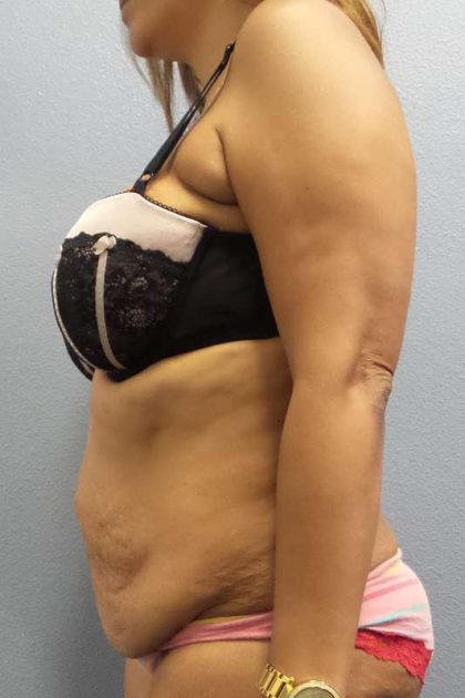 Abdominoplasty Before & After Patient #3763
