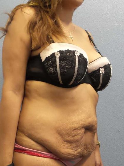 Abdominoplasty Before & After Patient #3763