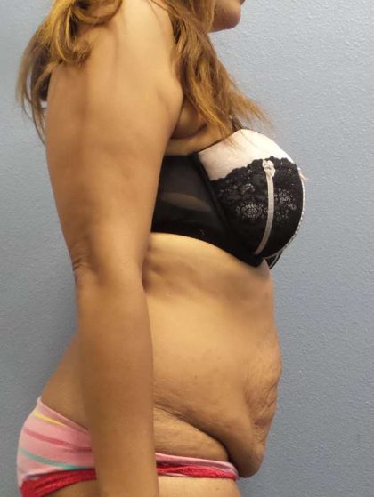 Abdominoplasty Before & After Patient #3763