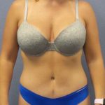 Abdominoplasty Before & After Patient #3177