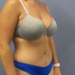 Abdominoplasty Before & After Patient #3177
