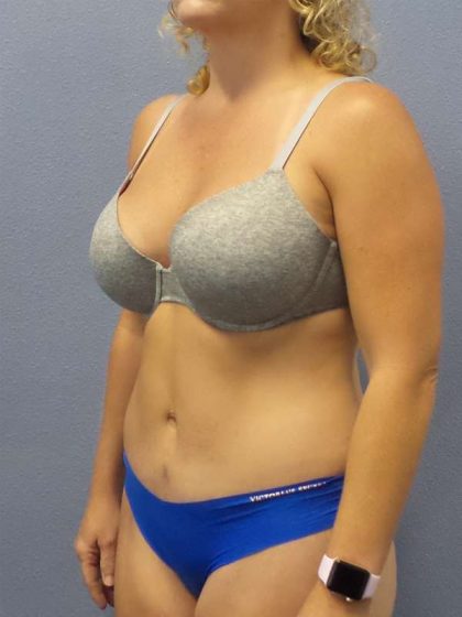 Abdominoplasty Before & After Patient #3177