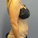 Abdominoplasty Before & After Patient #3177