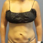 Abdominoplasty Before & After Patient #3177
